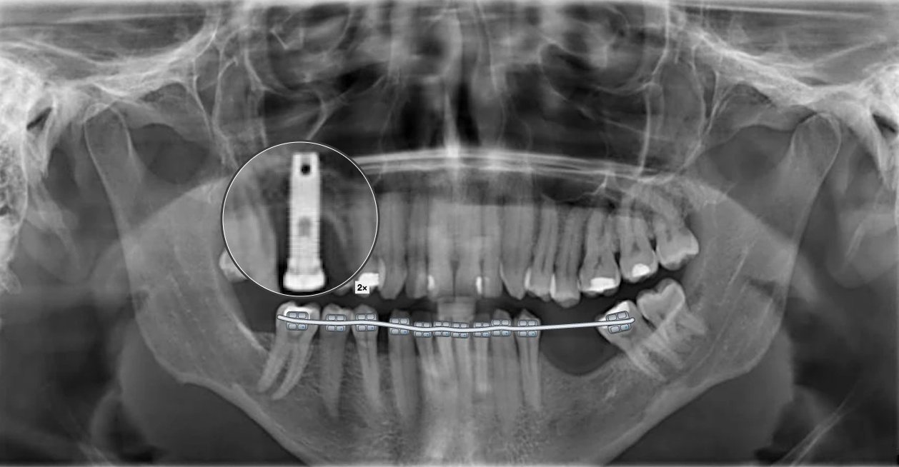 Radiografia panorâmica com desenhos do BazzoDentDraw: Aparelho no arco inferior e o implante ampliado com a lupa.