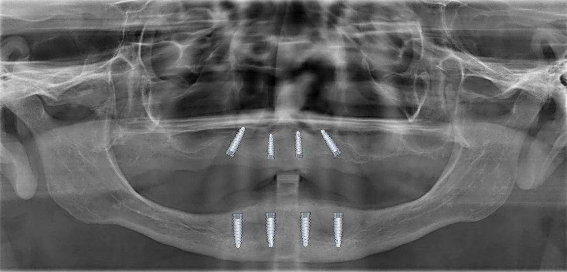 Radiografia panorâmica com desenhos do BazzoDentDraw: Posição dos implantes superiores e inferiores, antes da cirurgia.