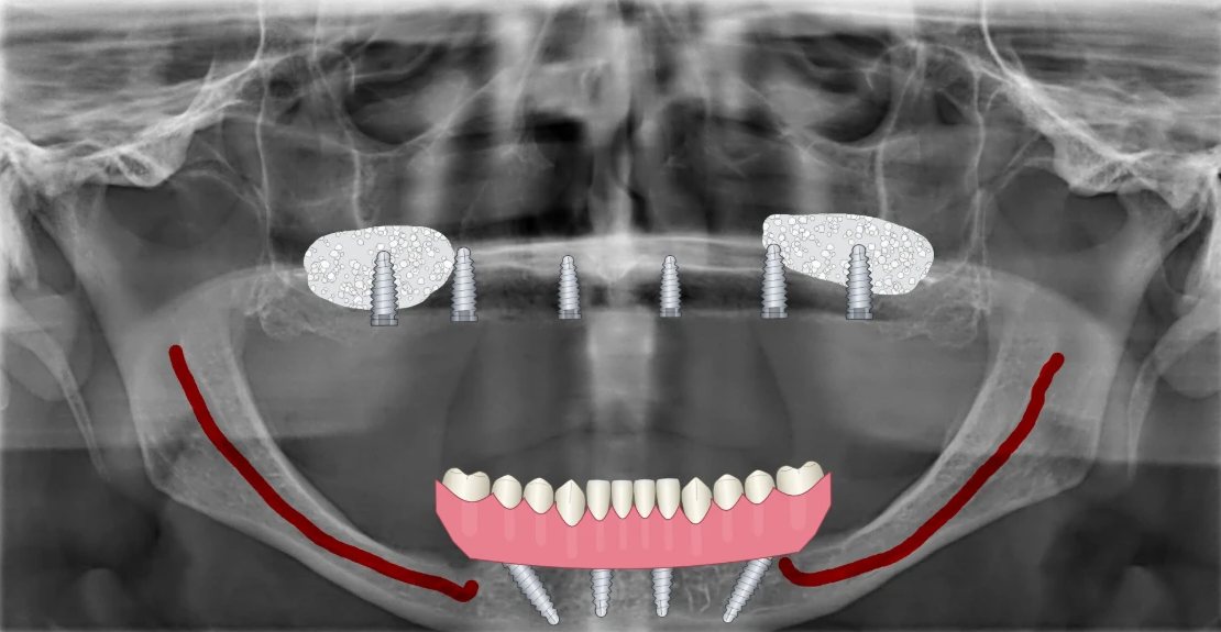 Radiografia panorâmica com desenhos do BazzoDentDraw: Protocolo sobre implantes, enxerto nos seios maxilares e o canal mandibular marcado.
