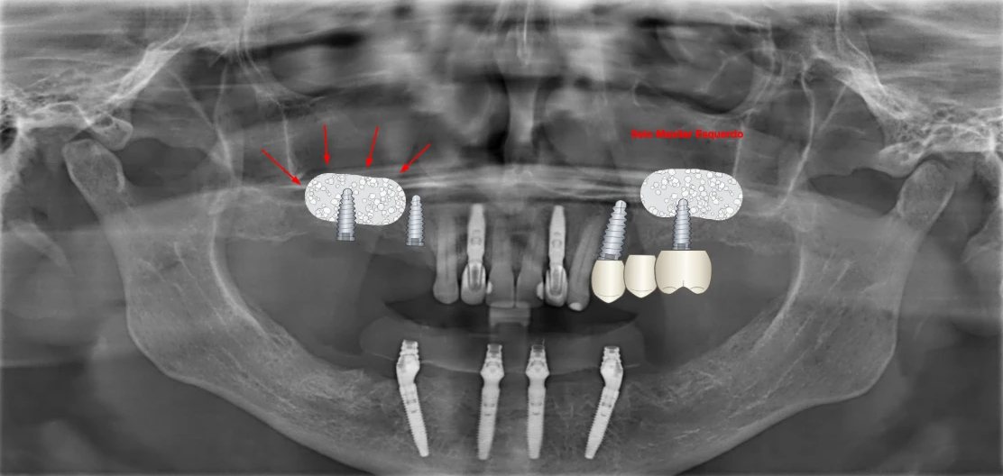 Radiografia panorâmica com desenhos do BazzoDentDraw: Enxerto no seio maxilar, implantes e coroas, com setas para explicar.