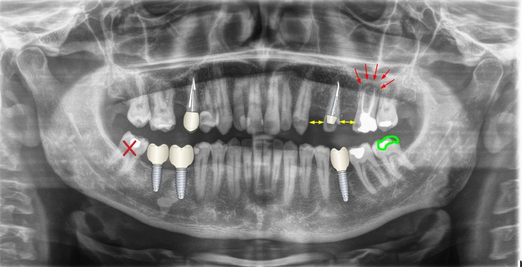 Radiografia panorâmica com desenhos do BazzoDentDraw: Implantes com coroa, pino e núcleo, extração, setas e marca-texto.